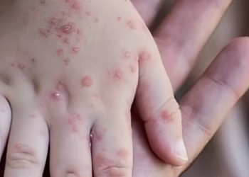 Mengenal Gejala Flu Singapura dan Upaya Pencegahannya