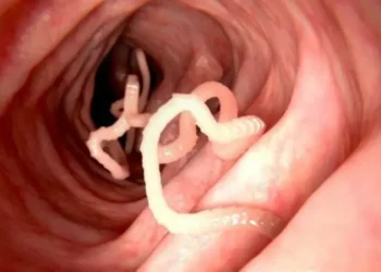 Mengintip 4 Jenis Penyakit Cacingan yang Masih Mengancam Anak-anak di Indonesia