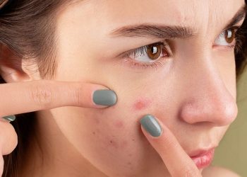 Waspadai 4 Penyebab Jerawat Muncul di Tempat Sama yang Sering Tak Disadari