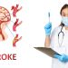 Gejala Awal Stroke pada Usia Muda yang Penting Diketahui