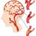 Begini Pencegahan Stroke Usia Muda yang Perlu Diketahui Milenial